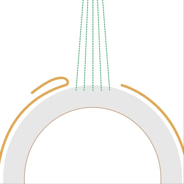 lasik2 1